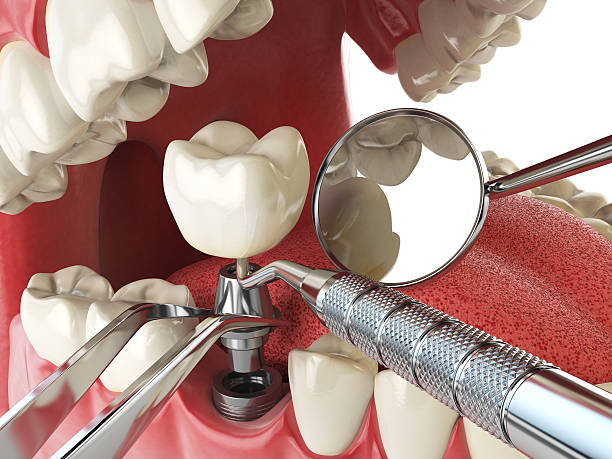 Best Emergency Tooth Extraction in Adrian, MO
